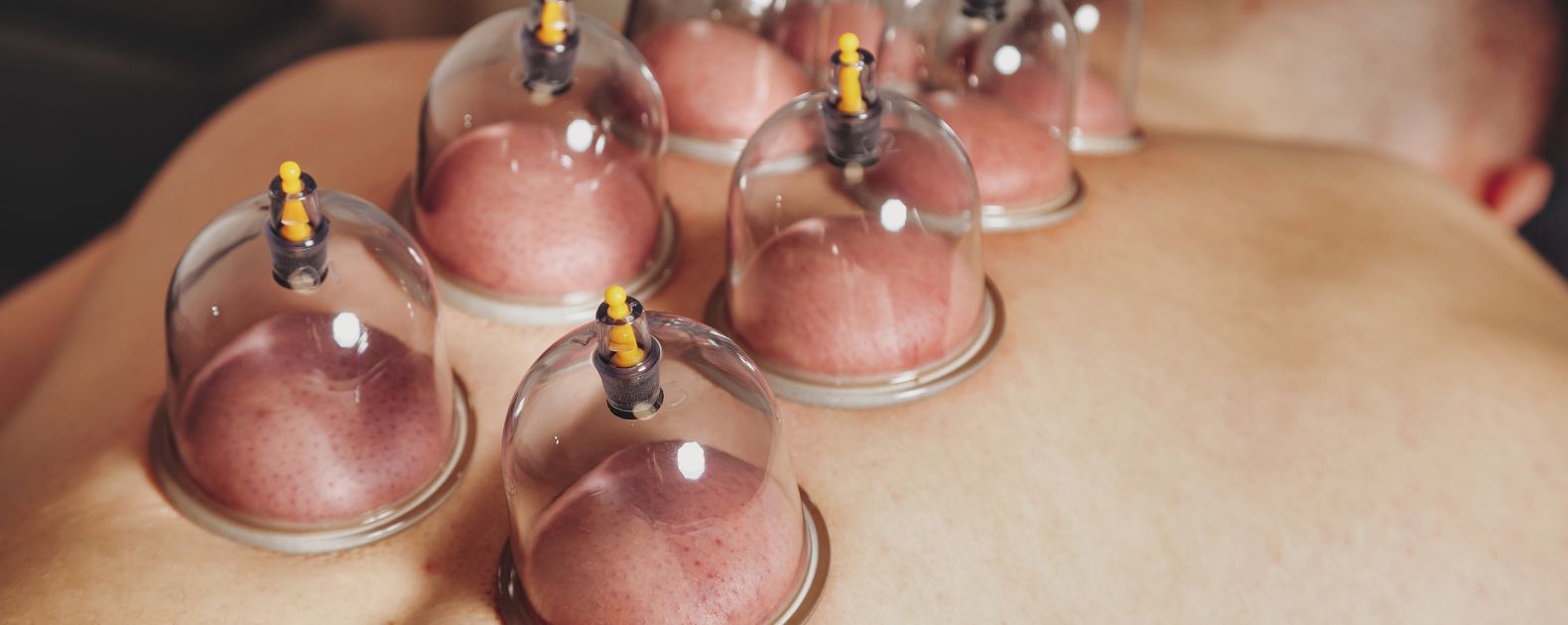 FACIAL CUPPING THERAPY FACIAL CUPPING THERAPY